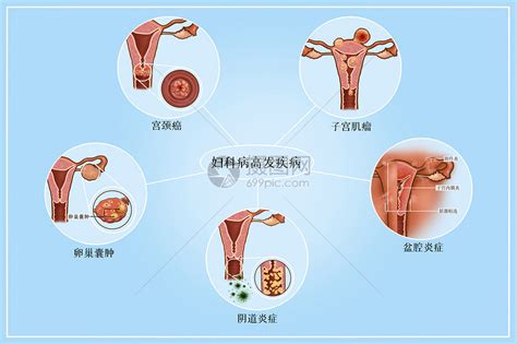 妇科病|妇科病